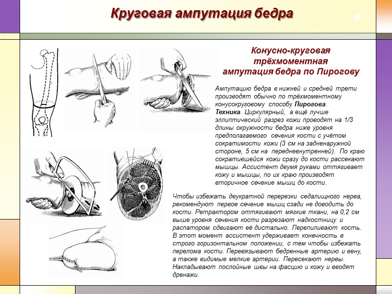 Круговая ампутация бедра Чтобы избежать двукратной перерезки седалищного нерва, рекомендуют первое сечение мышц сзади